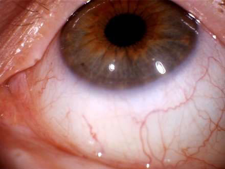 Sclera Up